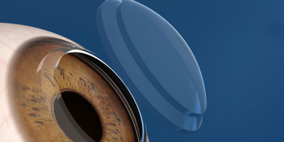 عملية زراعة القرنية بالفمتوليزر في مصر