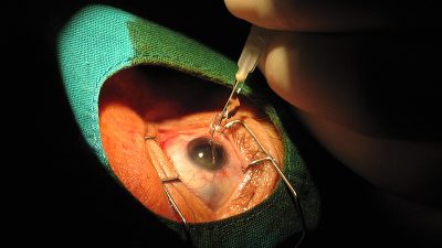 حقن الشبكية لمرضى السكري