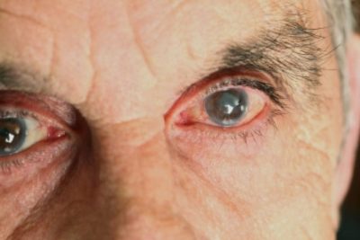 تكلفة حقن العين لعلاج الارتشاح