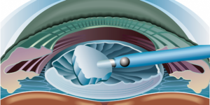 Cataract Surgery